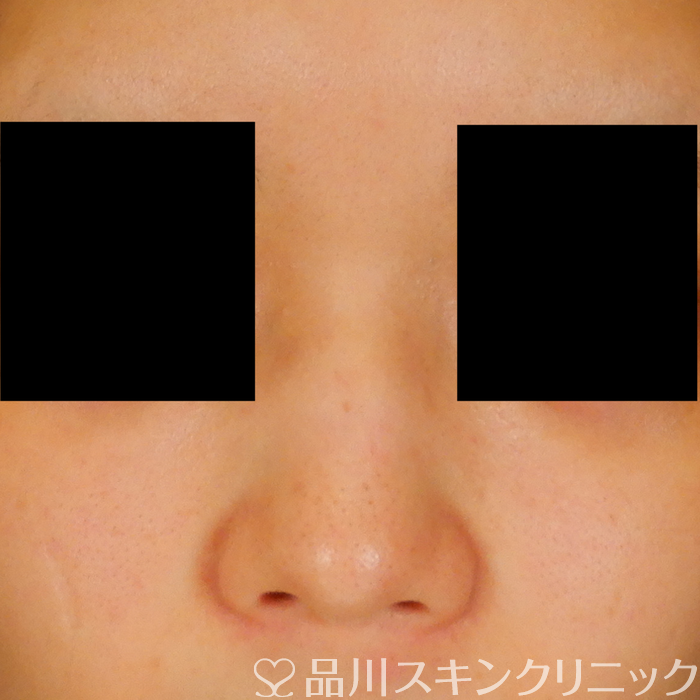 症例NO.63190のBEFORE写真