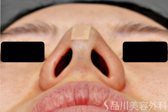 症例NO.73567のAFTER写真