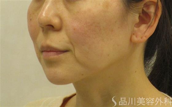 症例NO.59092のBEFORE写真