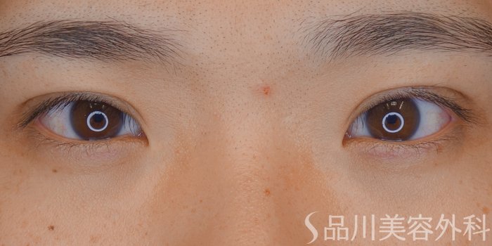 症例NO.70414のAFTER写真