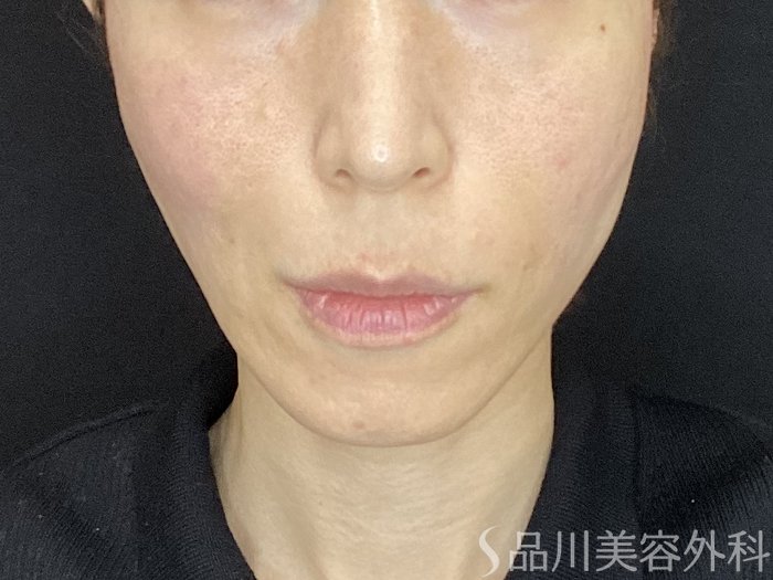 症例NO.72126のAFTER写真