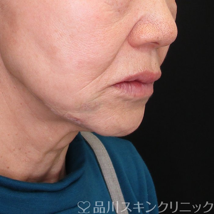 症例NO.73673のAFTER写真