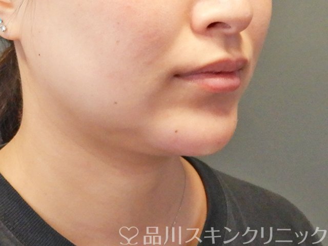 症例NO.65569のAFTER写真