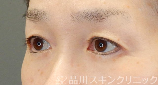 症例NO.65457のBEFORE写真