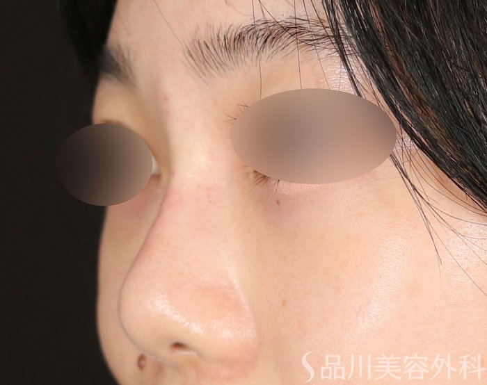 症例NO.71741のAFTER写真