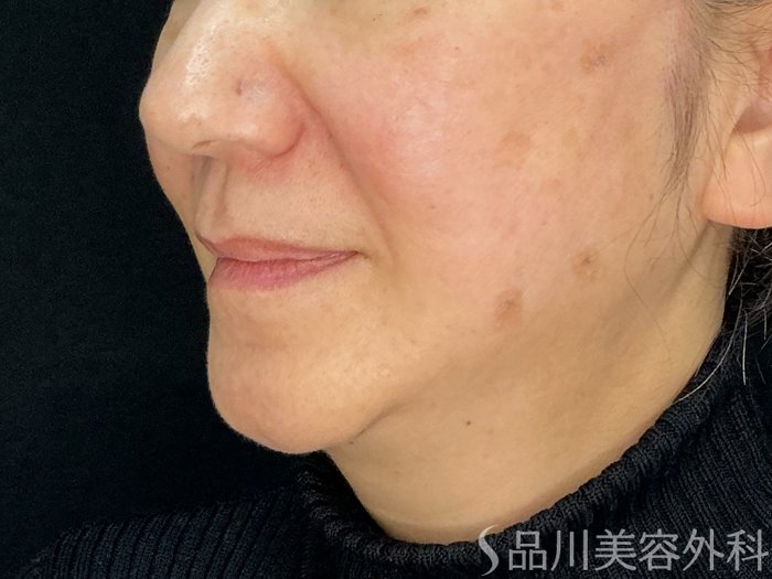 症例NO.72660のAFTER写真