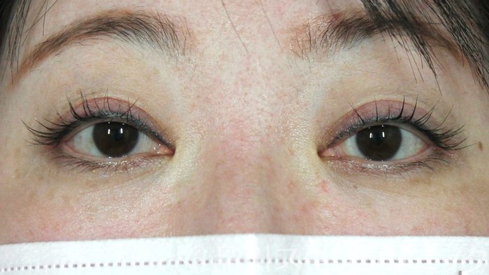 症例NO.72430のAFTER写真