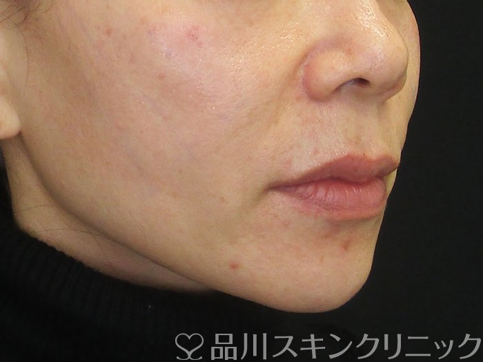 症例NO.72854のAFTER写真