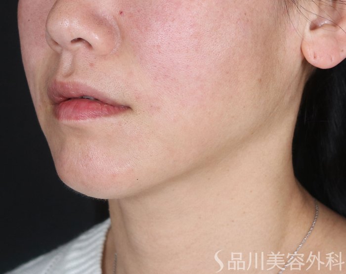 症例NO.73569のAFTER写真