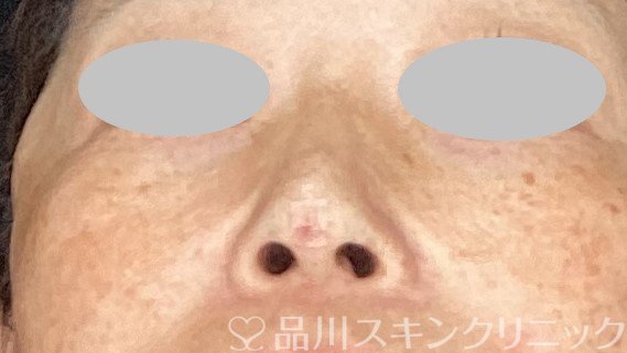 症例NO.63100のAFTER写真