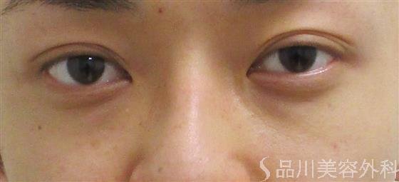 症例NO.55814のBEFORE写真