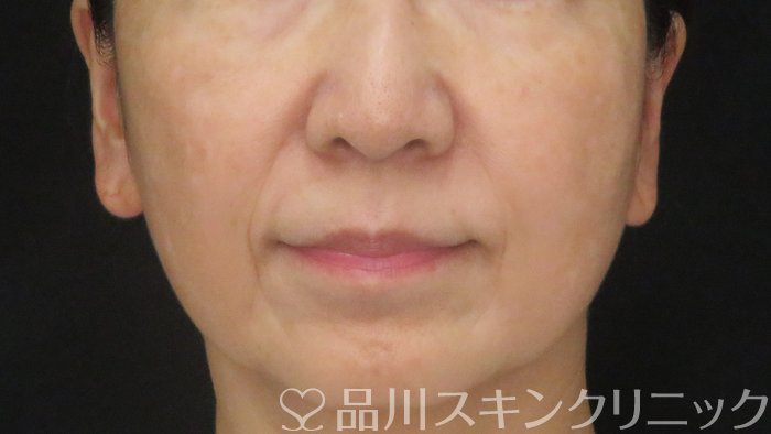 症例NO.72014のBEFORE写真