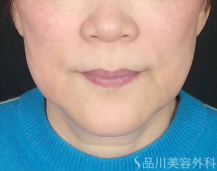 症例NO.69342のBEFORE写真
