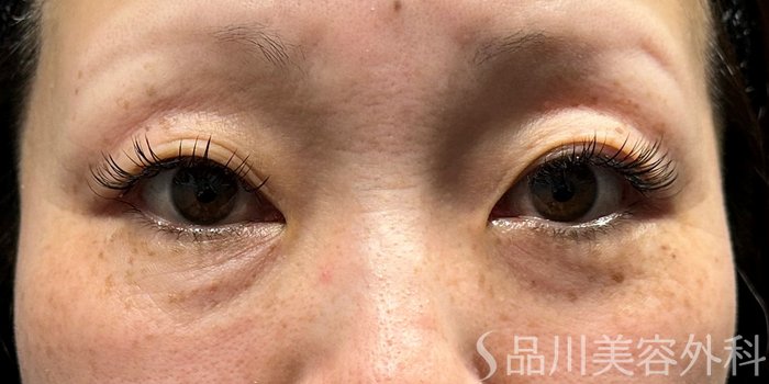 症例NO.70181のBEFORE写真