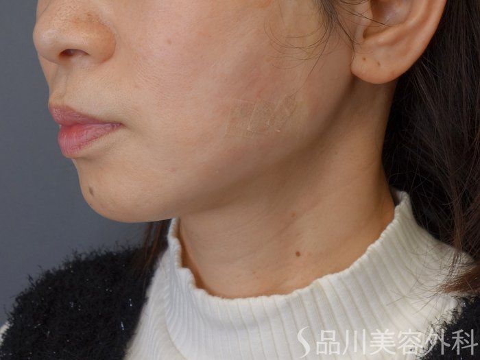 症例NO.72873のAFTER写真