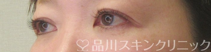 症例NO.73753のAFTER写真