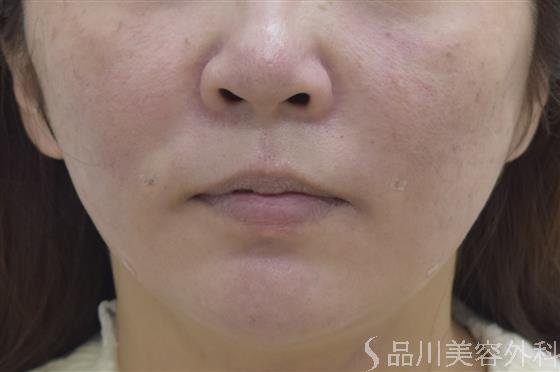 症例NO.46122のAFTER写真