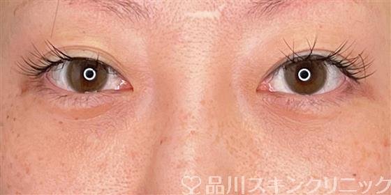 症例NO.57302のAFTER写真