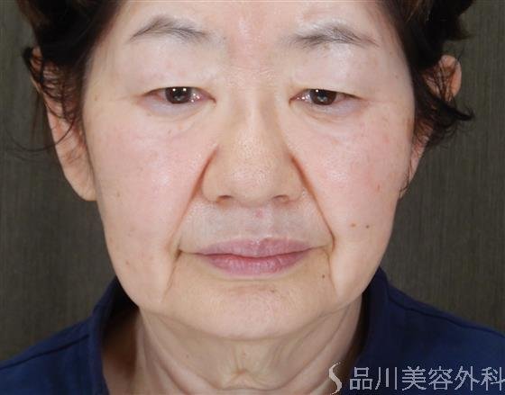 症例NO.60063のBEFORE写真