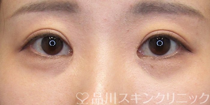 症例NO.75157のBEFORE写真