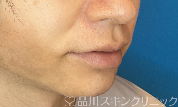 症例NO.74608のAFTER写真