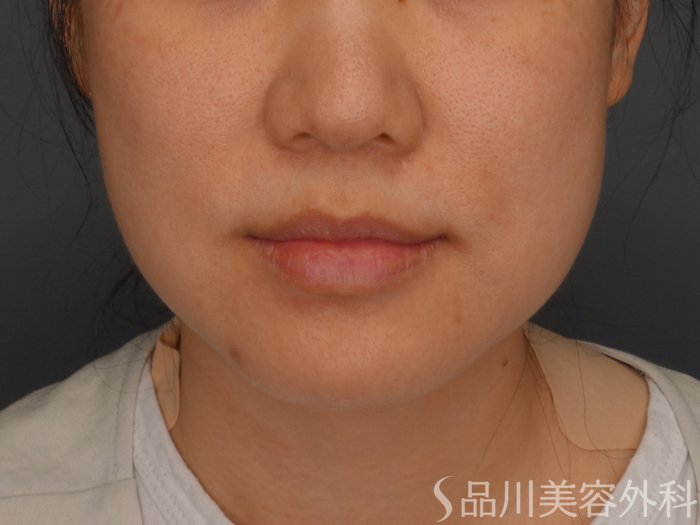 症例NO.64799のBEFORE写真