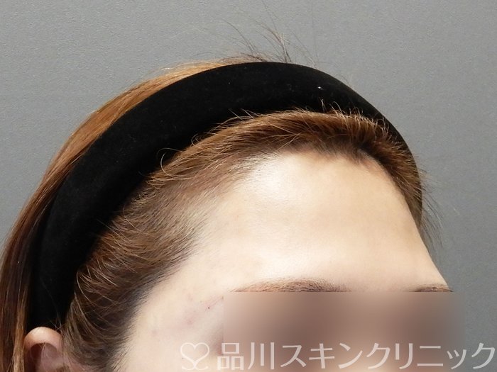 症例NO.73207のAFTER写真