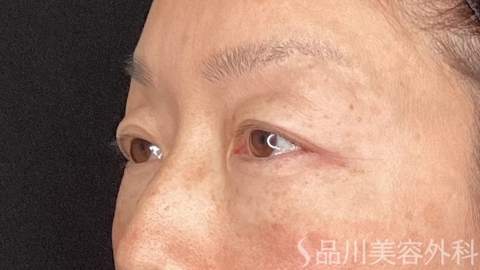 症例NO.64489のBEFORE写真