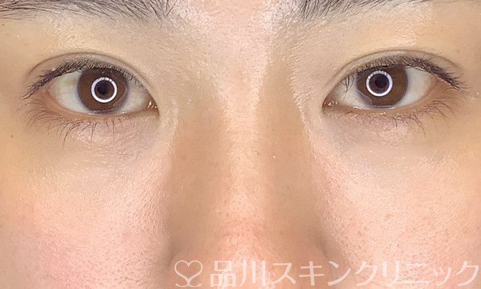 症例NO.65301のAFTER写真