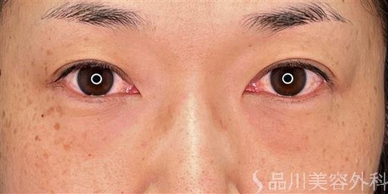 症例NO.54398のBEFORE写真