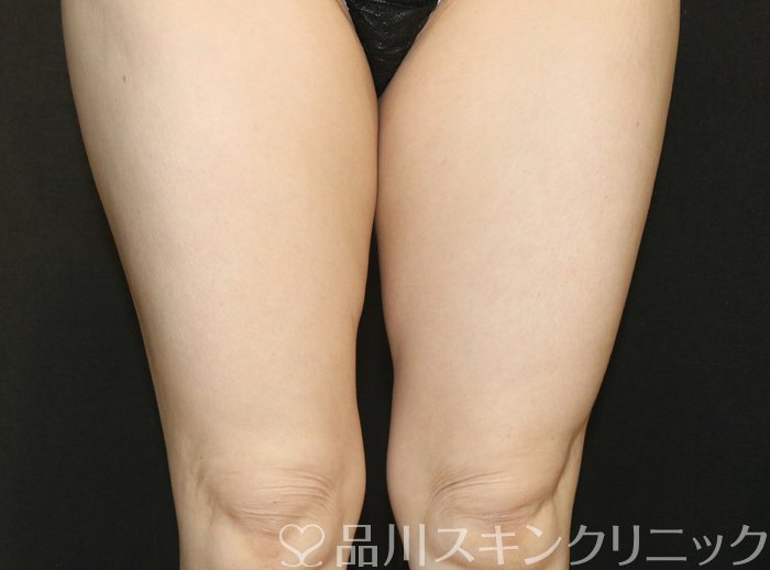 症例NO.72808のAFTER写真