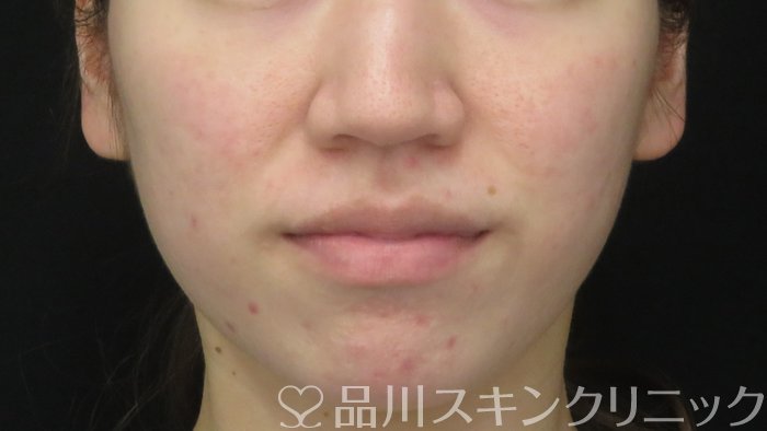 症例NO.71780のBEFORE写真