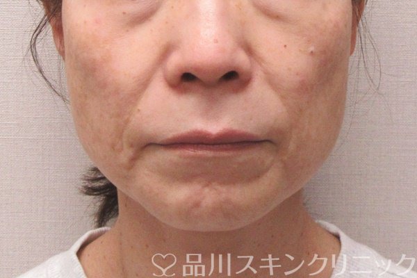 症例NO.69973のBEFORE写真