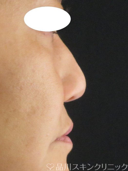 症例NO.65567のBEFORE写真