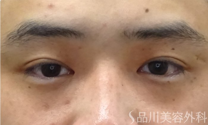 症例NO.69397のAFTER写真