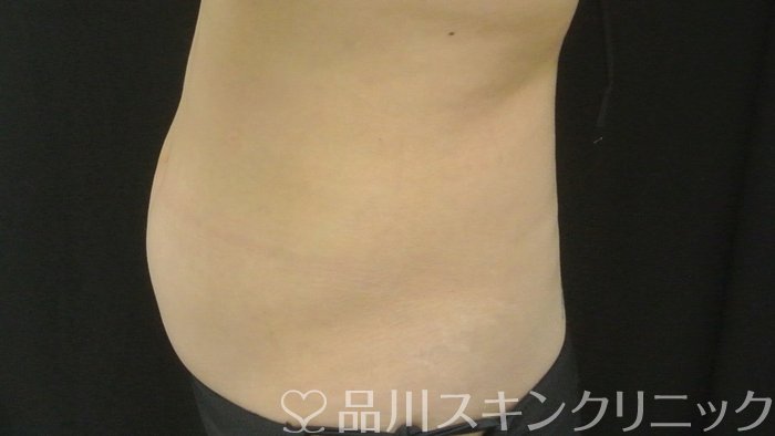 症例NO.70814のBEFORE写真