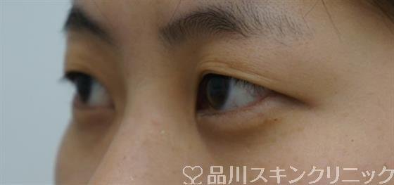 症例NO.40435のBEFORE写真