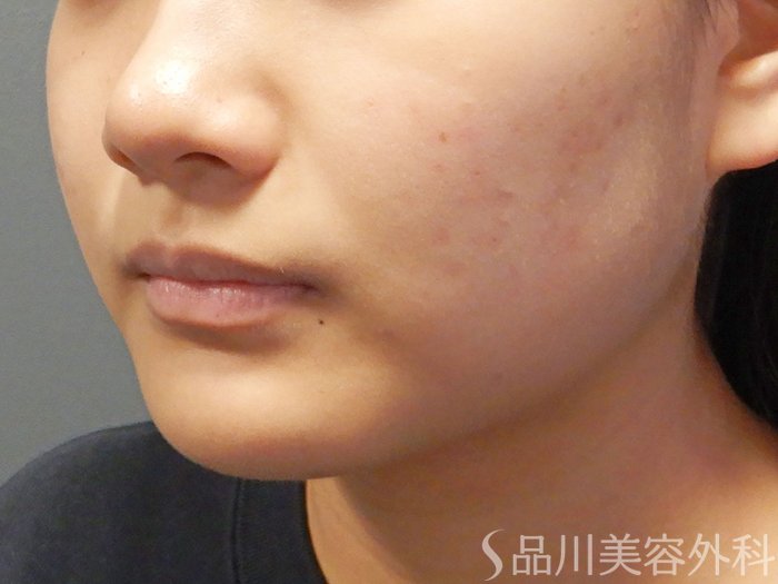 症例NO.72102のAFTER写真