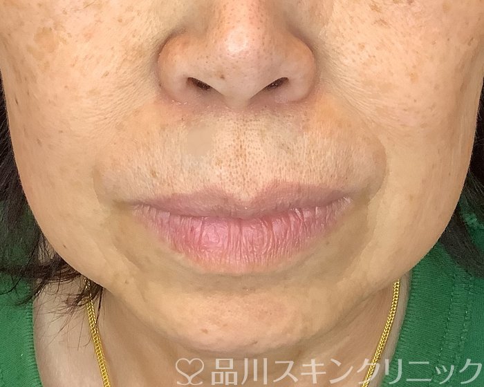 症例NO.70371のBEFORE写真