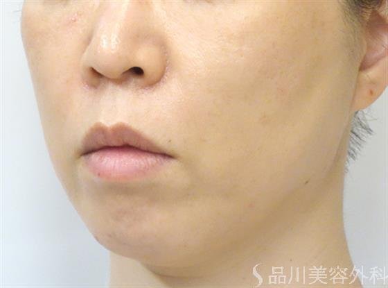 症例NO.27053のAFTER写真