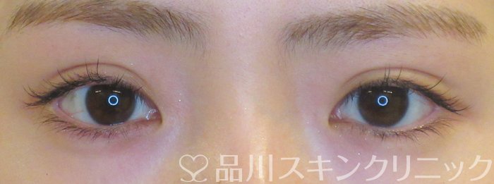 症例NO.68441のAFTER写真