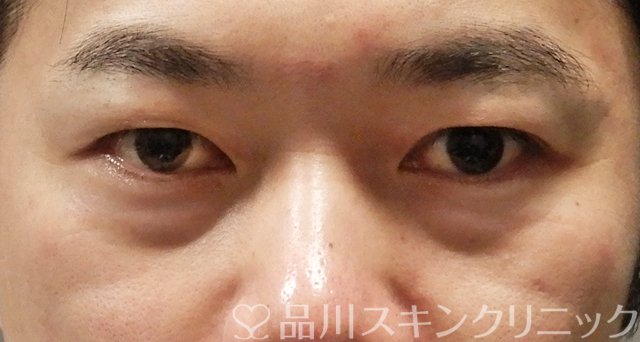 症例NO.67688のBEFORE写真