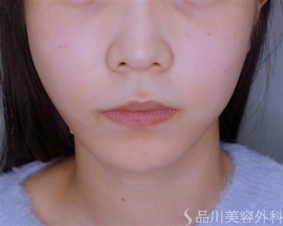 症例NO.53252のAFTER写真