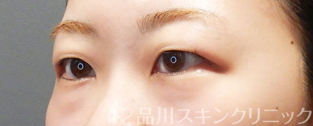 症例NO.75076のBEFORE写真