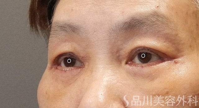 症例NO.73848のAFTER写真