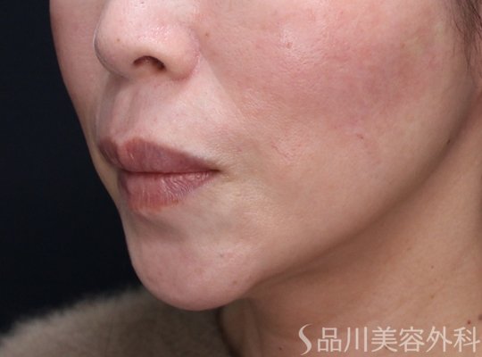 症例NO.73109のAFTER写真