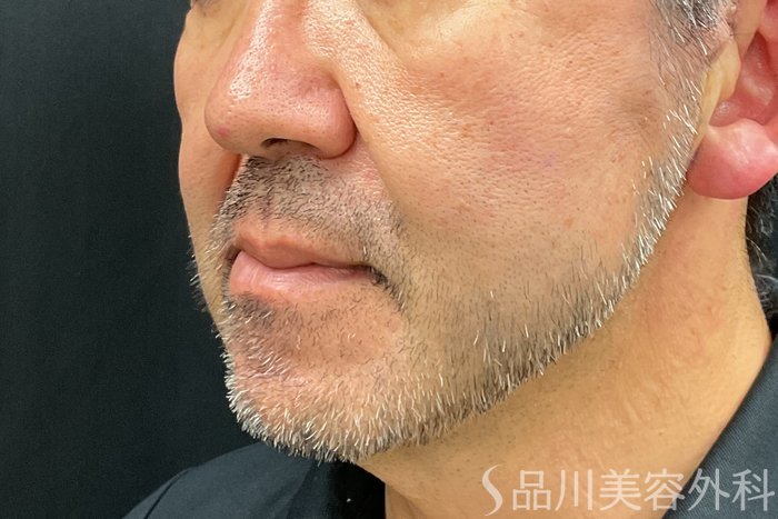 症例NO.71246のAFTER写真