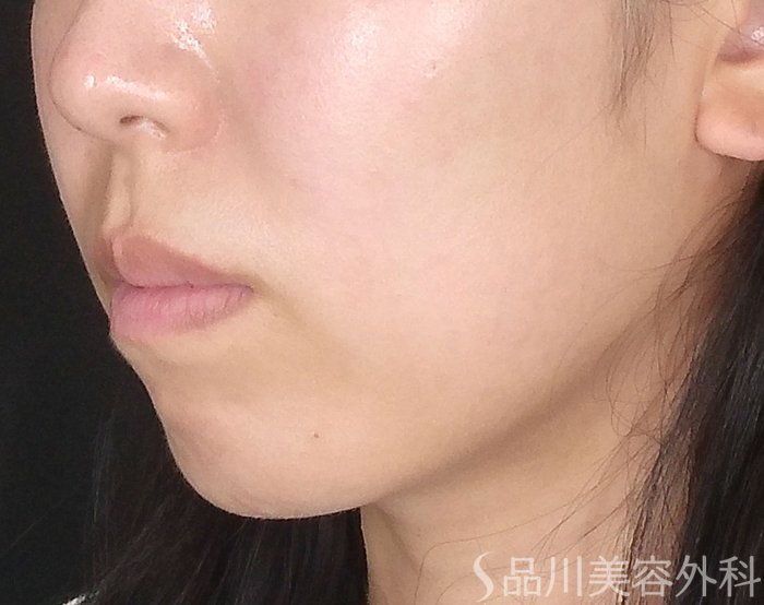 症例NO.64879のBEFORE写真