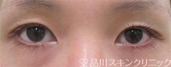 症例NO.26879のBEFORE写真