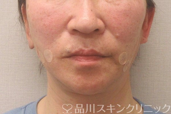 症例NO.75165のAFTER写真